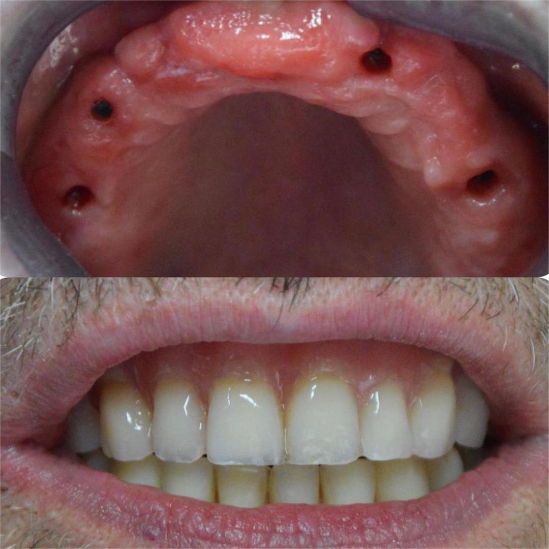 Implantología y Prótesis